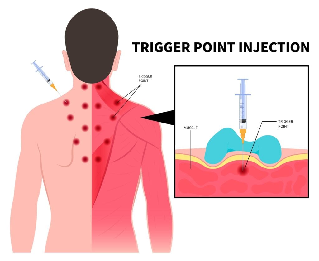 Trigger Point Injections Process-min